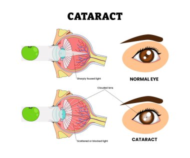 Katarakt ya da Bulutlu Göz Merceği, Göz Görme Sorunu, Eğitimsel Tıbbi Poster Tasarımı Şeması, Göz Hastalığı ve Görme Sorunu, Tıbbi Retina Sağlığı Sorunu.