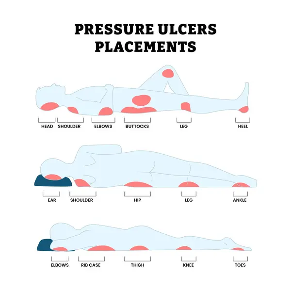 Farklı tip basınç ülser yerleştirme tipleri. İnsan uzuvları üzerindeki basınç alanı, farklı pozisyonlardaki yatak yarası, sağlık, hemşirelik ve hasta bakımı eğitimi için kullanışlı.