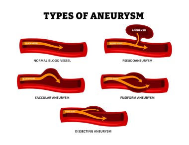 Farklı anevrizma tipleri koleksiyon oluşturur. Aort ya da beyindeki anormal arter. Psödoanevrizması olan etiketli kan damarı, sakküler, fusiform, diseksiyon anevrizması. Tıbbi poster bilgileri.
