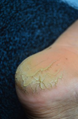 Topuğu çok kötü kırılmış. Kuru derili insan ayakları. Çirkin ve sağlıksız ayaklı çıplak ayaklı bir adam. Salon tedavisi ve deri prosedürü konsept gerektiriyordu. Çatlamış kuru deri, ayak tedavisi..