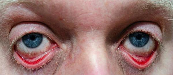 Red swollen eyelids and eyeballs in an adult male close-up