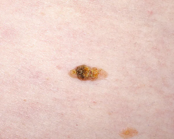 Senile keratosis on the skin. Nevus or mole. Skin diseases