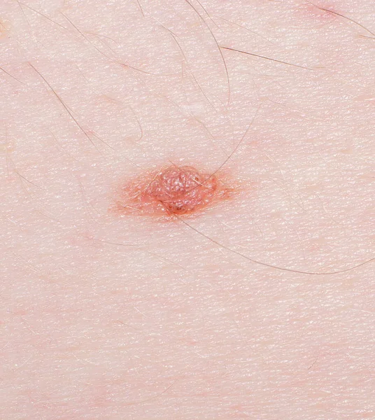 皮膚の上のネバス 黒色腫またはがん 皮膚科 — ストック写真