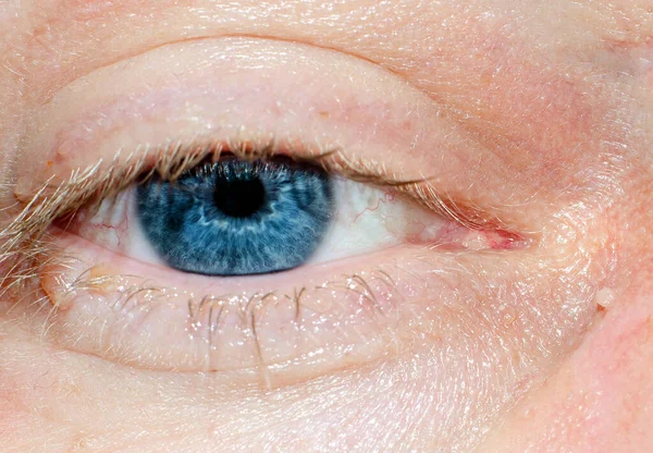 Papillomavirus Eye Close — Stock Photo, Image
