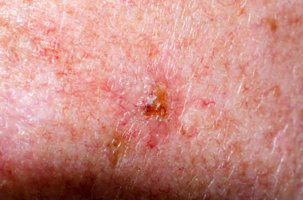 Nevus Papilloma Mole Melanoma Keratosis Skin Adult — Stock Photo, Image
