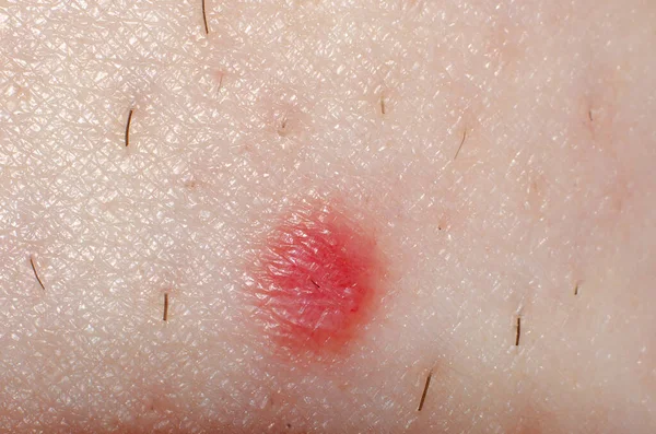 Nevus Papilloma Mole Melanoma Skin Adult — Stock Photo, Image