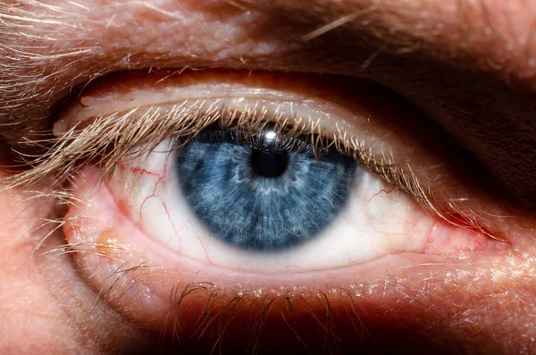眼睑上有乳头状瘤的成年人的蓝眼睛 — 图库照片
