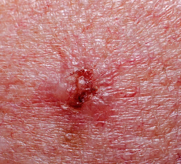 Καρκίνος Στο Κρανίο Επουλωτική Πληγή Του Δέρματος — Φωτογραφία Αρχείου