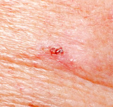 Yetişkin birinin cildinde bazaliom.