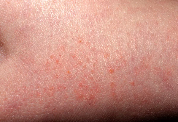 Alergia Skórze Dziecka Bliska — Zdjęcie stockowe