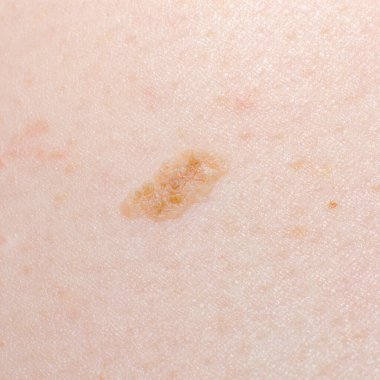Nevus ya da insan vücudundaki ben. Cilt kanseri, keratoz veya ciltte melanom.