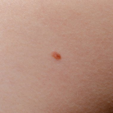 Nevus ya da insan derisindeki ben. Yakın plan..