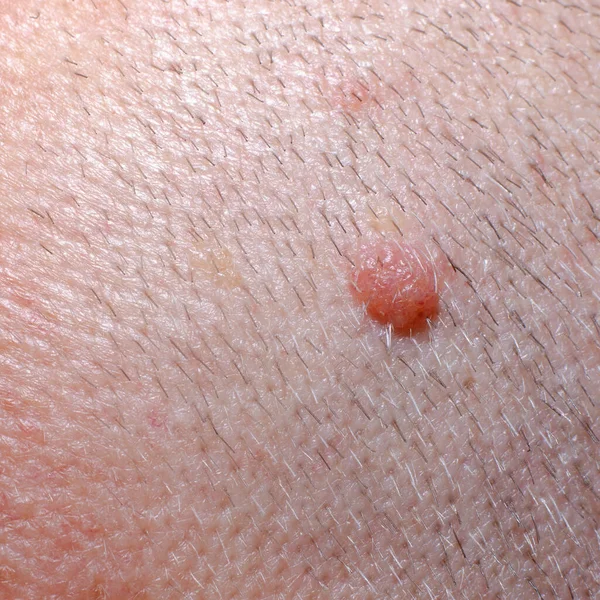 Nevus Mole Skin Human Body Close — Stock Photo, Image