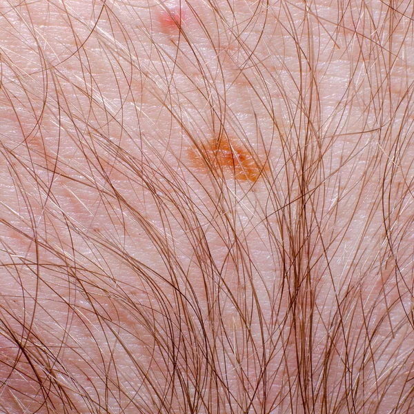 Naevus Oder Maulwurf Menschlichen Körper Aus Nächster Nähe Hautkrebs Keratose — Stockfoto