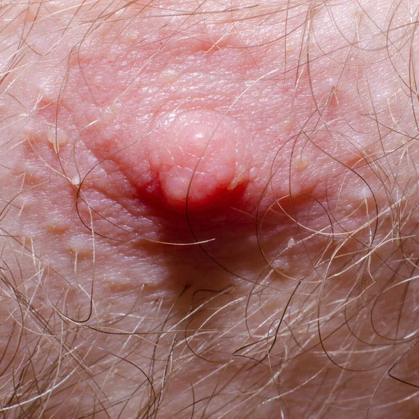 Papillomas Nipple Adult Male Close — Stock Photo, Image