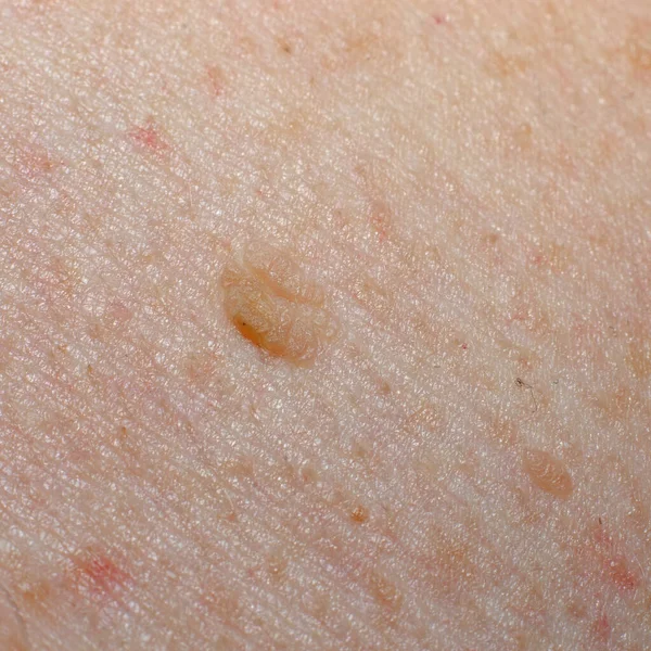 인간의 사마귀를 클로즈업하는 피부암 각기병 피부에 생기는 흑색종 — 스톡 사진
