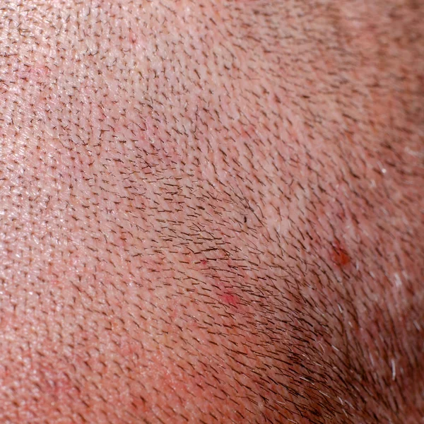 Rasierte Menschliche Haut Auf Dem Kopf Großaufnahme — Stockfoto