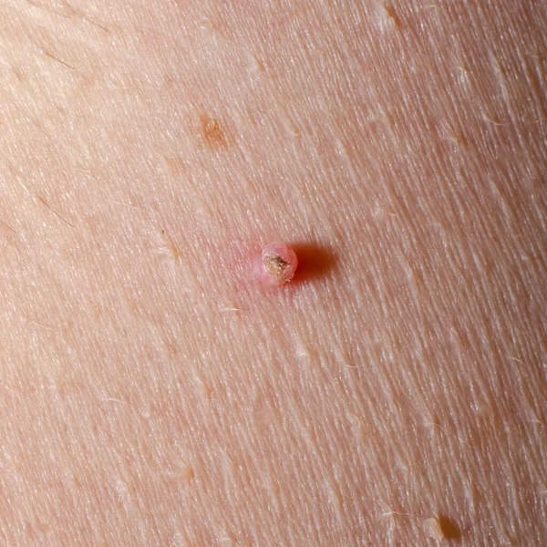 Ένα Τραύμα Ένα Νεφρό Ανθρώπινο Δέρμα Από Κοντά Κατεστραμμένη Ελιά — Φωτογραφία Αρχείου