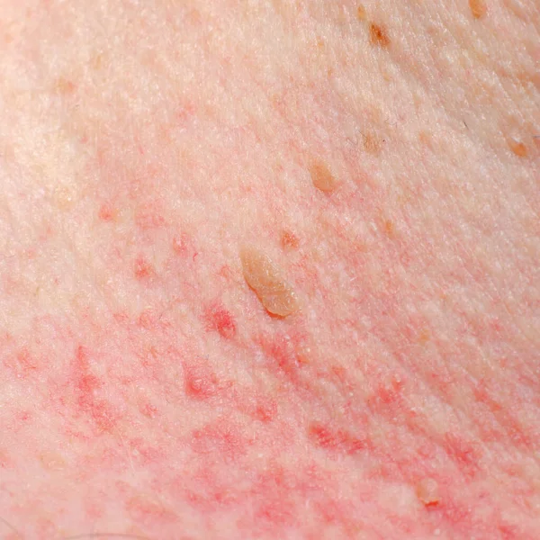 Keratose Papilloom Huid Van Een Volwassene Irritatie Allergische Reactie — Stockfoto