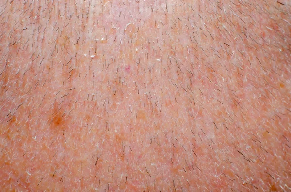 Подстриженные Волосы Голове Взрослого Мужчины Крупным Планом Scalp — стоковое фото