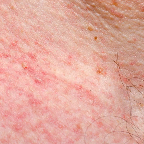 成人の皮膚上のケラトシスや乳頭腫 刺激又はアレルギー反応 — ストック写真