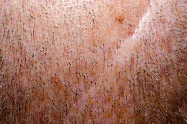 Obcięte Włosy Głowie Dorosłego Mężczyzny Bliska Skóry Głowy — Zdjęcie stockowe