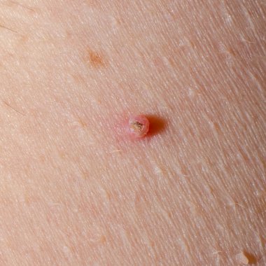 İnsan vücudunda yarası ya da nevusu olan bir ben. Papilloma iltihabı.