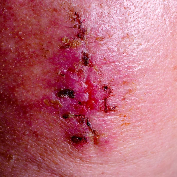 Wound Removal Stitches Skin Cancer Surgery — Stock Photo, Image