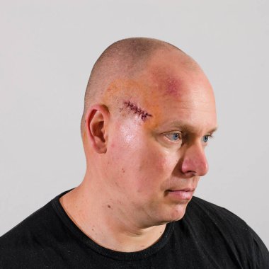 Cilt kanseri ameliyatından sonra kafasında sıva olan yetişkin bir adam.