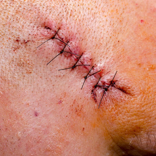 머리에 피부암을 제거한 외과용 스레드로 바느질된 스톡 사진