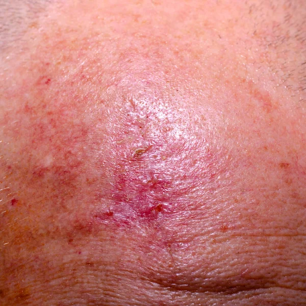 Cicatrice Après Chirurgie Pour Éliminer Cancer Peau Sur Tête — Photo
