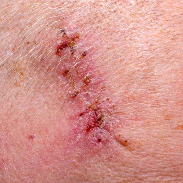 Wound Removal Threads Surgery — Stock Photo, Image