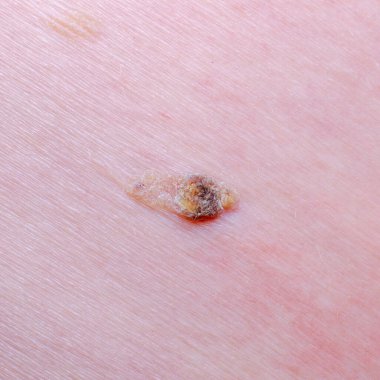 Nevus ya da bir yetişkinin derisindeki ben.
