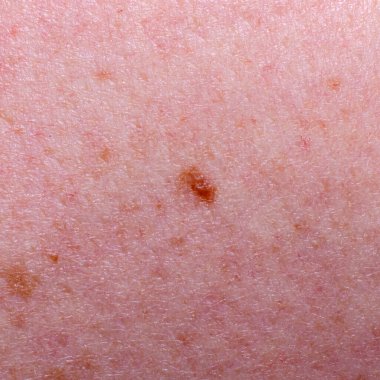 Nevus ya da bir yetişkinin derisindeki ben.