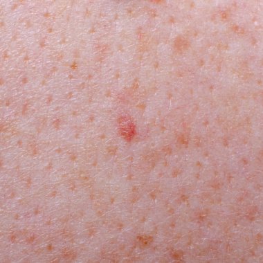 Nevus ya da bir yetişkinin derisindeki ben.