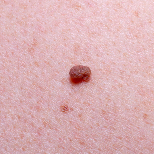 Nevus or mole on the skin of an adult