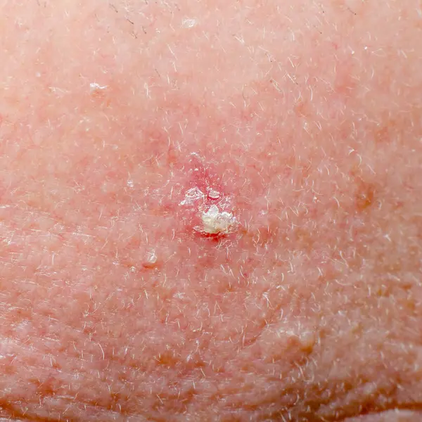 Yetişkin birinin kafa derisinde aktinik keratoz ya da bazal hücre kanseri