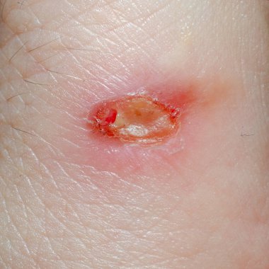 İnsan vücudu yarası. Tıraş olduktan sonra cilt tahrişi, sivilceler, sivilceler ve mantarlar..