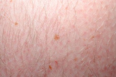 Tenindeki benler ya da beni olan pigment benekleri.