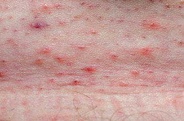 İnsan vücudu yarası. Tıraş olduktan sonra cilt tahrişi, sivilceler, sivilceler ve mantarlar..