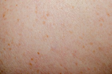 Nevus insan derisini yakından inceledi