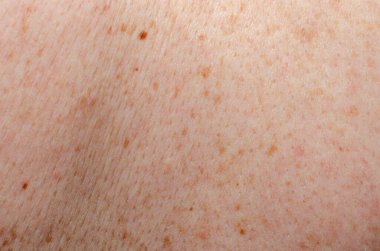 Nevus insan derisini yakından inceledi