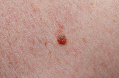 Nevus insan derisini yakından inceledi