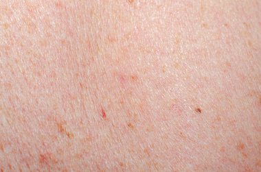 Nevus insan derisini yakından inceledi