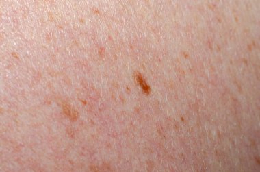 Nevus insan derisini yakından inceledi