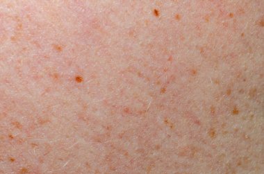 Nevus insan derisini yakından inceledi