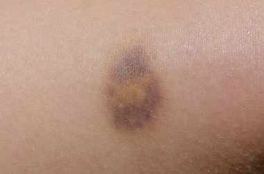 İnsan Derisi Yüzeyindeki Çürüklerin Yakın Çekimi