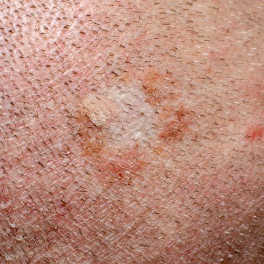 Kabukları ve kızarıklığı olan iltihaplı ve tahriş olmuş bir cilt.