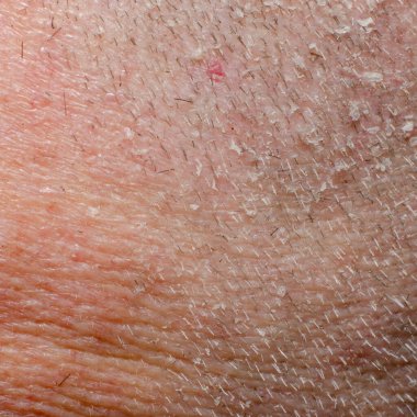 Kepekli Flaky Scalp 'ın yakın çekimi.