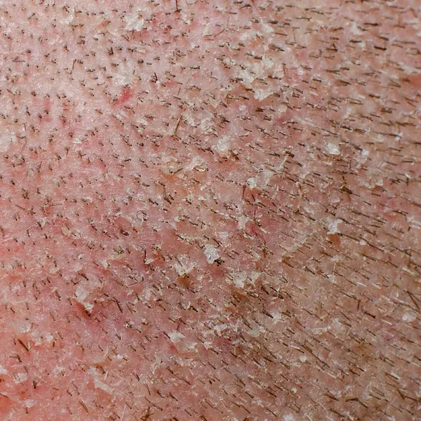  Kepekli Flaky Scalp 'ın yakın çekimi.